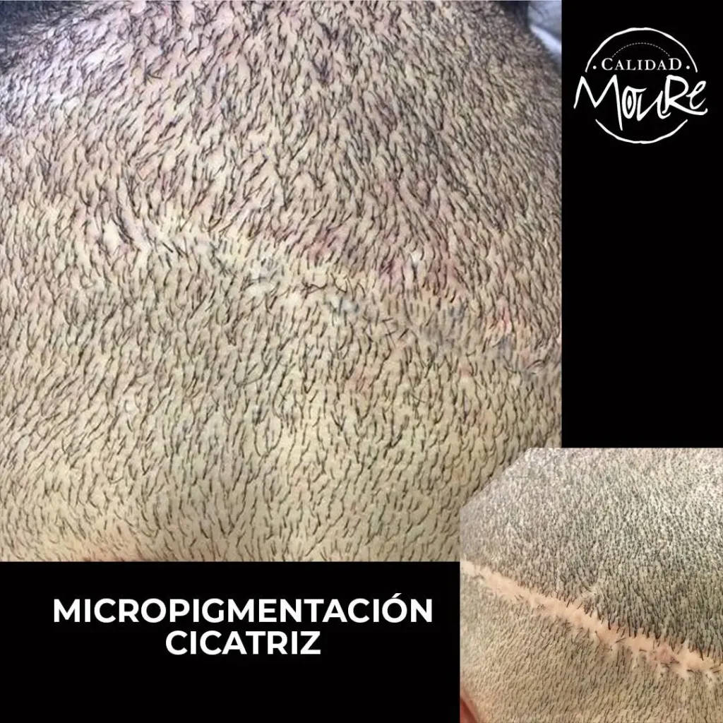 MICROPIGMENTACION-CAPILAR-CICATRICES-MOURE-6-1