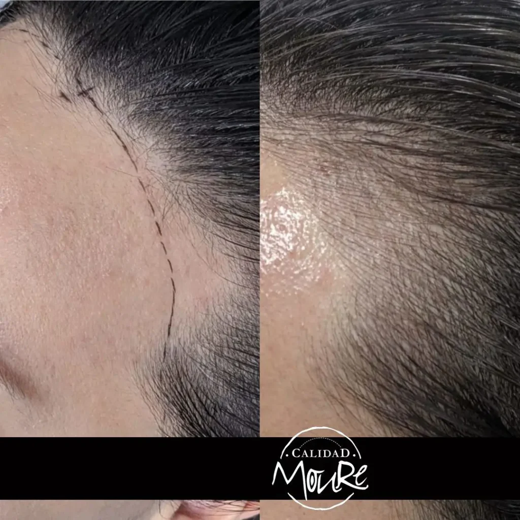MICROPIGMENTACION-MUJER-MOURE-MAS-DENSIDAD-PELO-LARGO-12