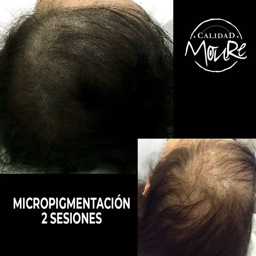 MICROPIGMENTACION-MUJER-MOURE-MAS-DENSIDAD-PELO-LARGO-15