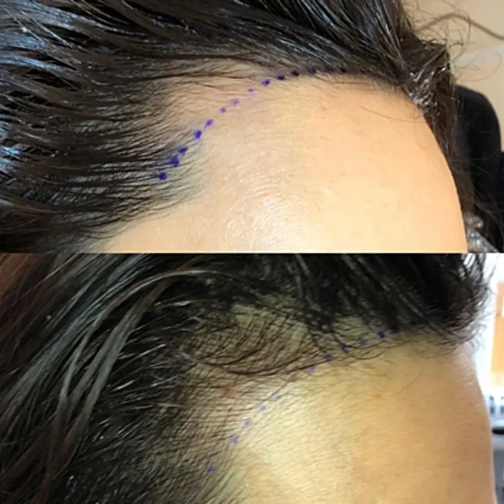MICROPIGMENTACION-MUJER-MOURE-MAS-DENSIDAD-PELO-LARGO-16
