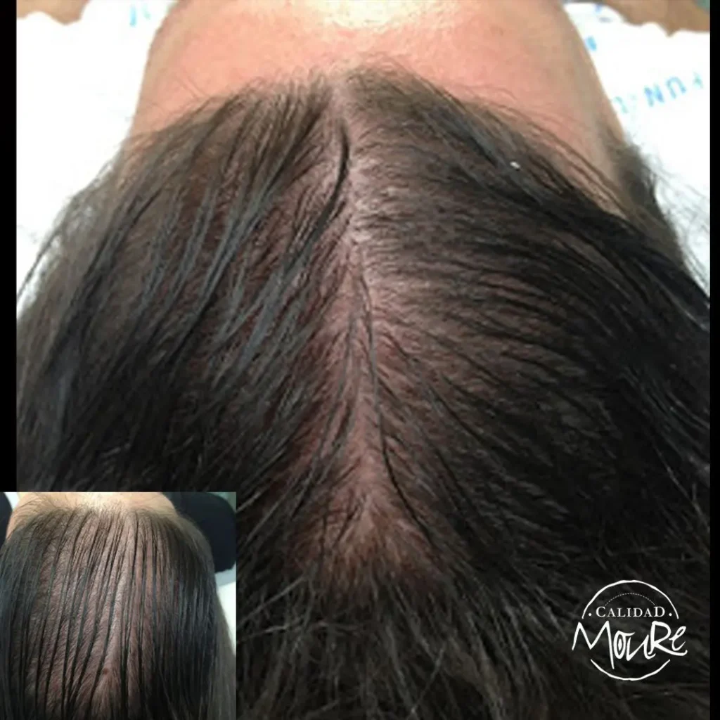 MICROPIGMENTACION-MUJER-MOURE-MAS-DENSIDAD-PELO-LARGO-3