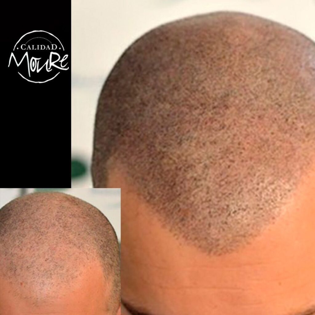MICROPIGMENTACION-RASURADO-MOURE-MALLORCA-10-1