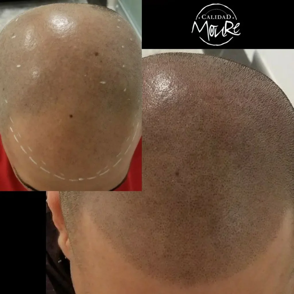 MICROPIGMENTACION-RASURADO-MOURE-MALLORCA-19