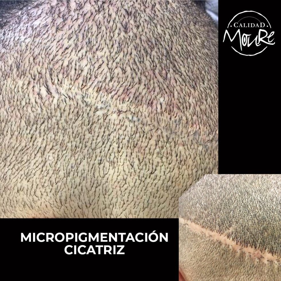 Micropigmentacion-Capilar-Mallorca-Calvicie-Cicatrices-01