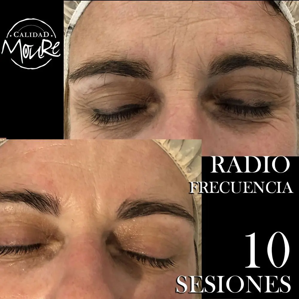 RADIOFRECUENCIA-LASER-GALVANICA-Y-ACIDO-HIALURONICO-CENTRO-DE-ESTETICA-MOURE-MALLORCA-1