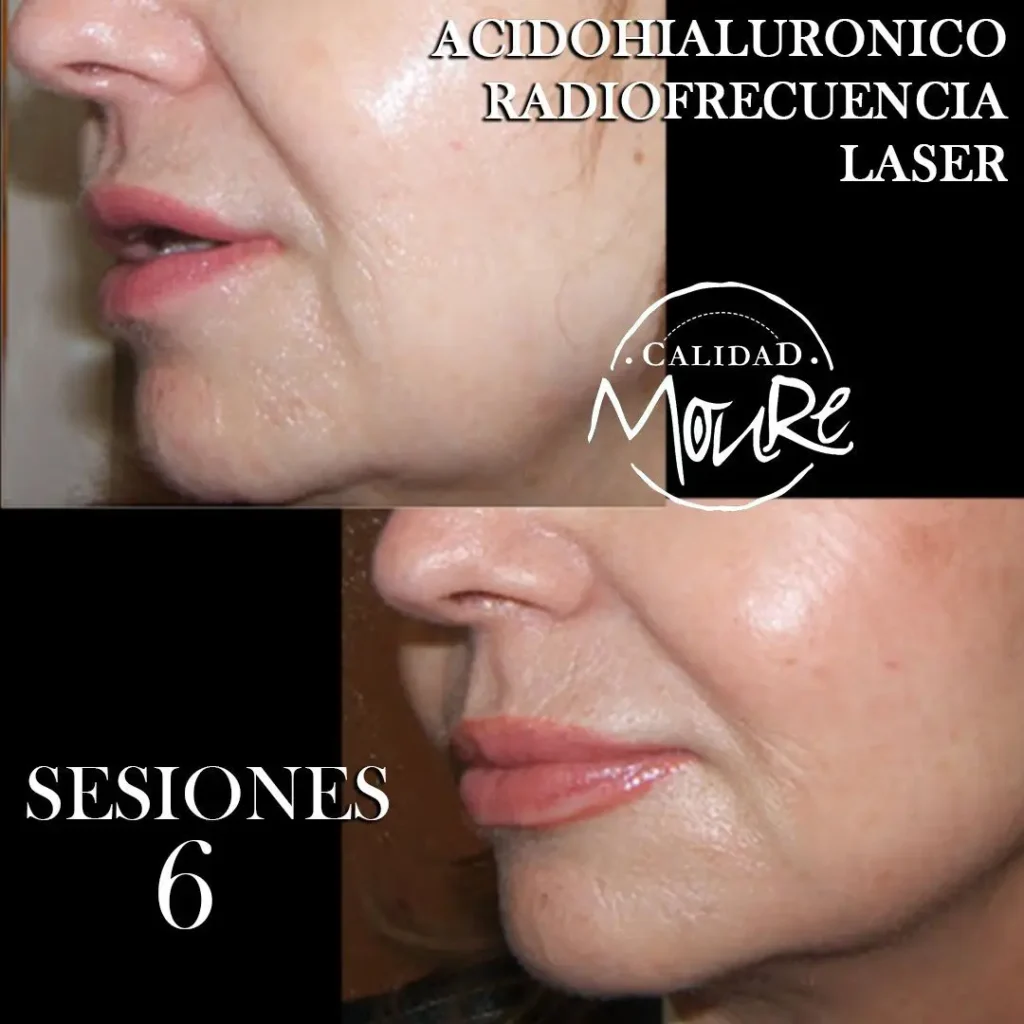 RADIOFRECUENCIA-LASER-GALVANICA-Y-ACIDO-HIALURONICO-CENTRO-DE-ESTETICA-MOURE-MALLORCA-10