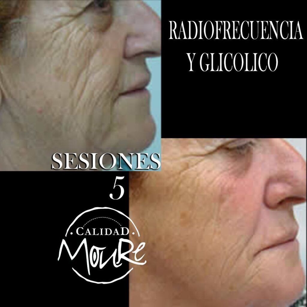 RADIOFRECUENCIA-LASER-GALVANICA-Y-ACIDO-HIALURONICO-CENTRO-DE-ESTETICA-MOURE-MALLORCA-11
