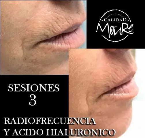 RADIOFRECUENCIA-LASER-GALVANICA-Y-ACIDO-HIALURONICO-CENTRO-DE-ESTETICA-MOURE-MALLORCA-12