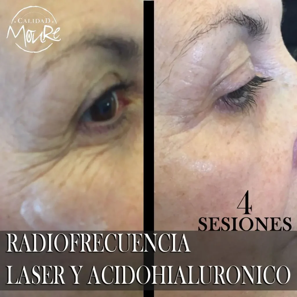 RADIOFRECUENCIA-LASER-GALVANICA-Y-ACIDO-HIALURONICO-CENTRO-DE-ESTETICA-MOURE-MALLORCA-2