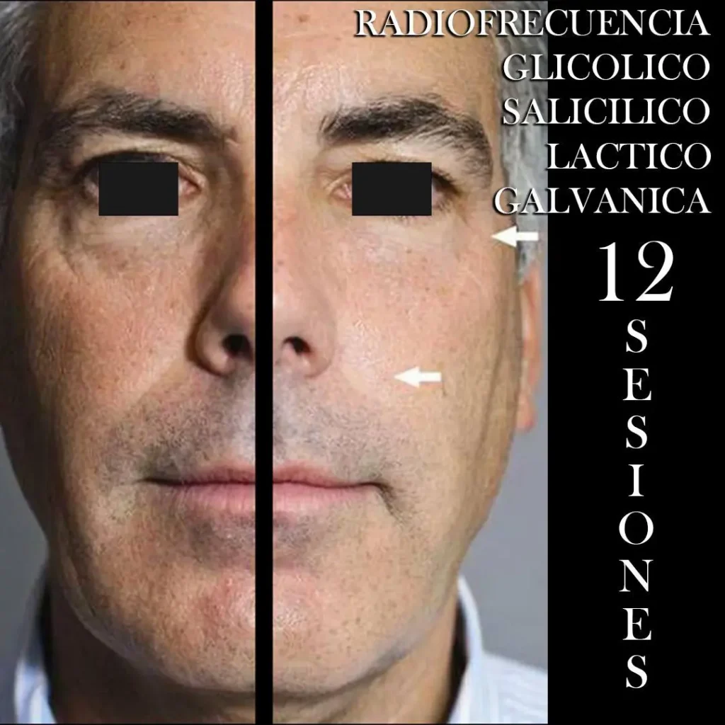 RADIOFRECUENCIA-LASER-GALVANICA-Y-ACIDO-HIALURONICO-CENTRO-DE-ESTETICA-MOURE-MALLORCA-3