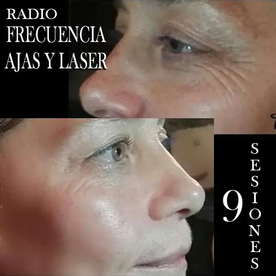 RADIOFRECUENCIA-LASER-GALVANICA-Y-ACIDO-HIALURONICO-CENTRO-DE-ESTETICA-MOURE-MALLORCA-4