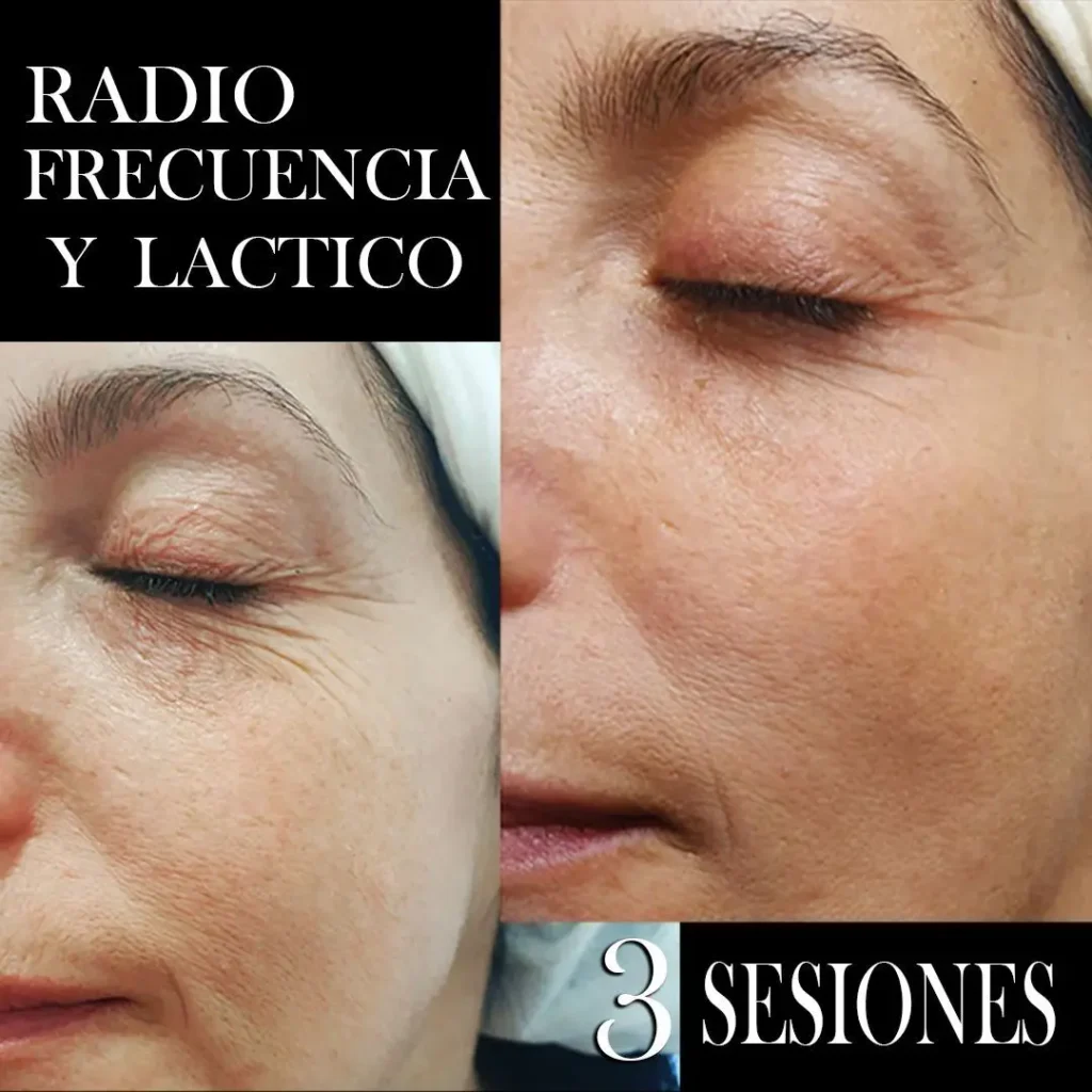 RADIOFRECUENCIA-LASER-GALVANICA-Y-ACIDO-HIALURONICO-CENTRO-DE-ESTETICA-MOURE-MALLORCA-5