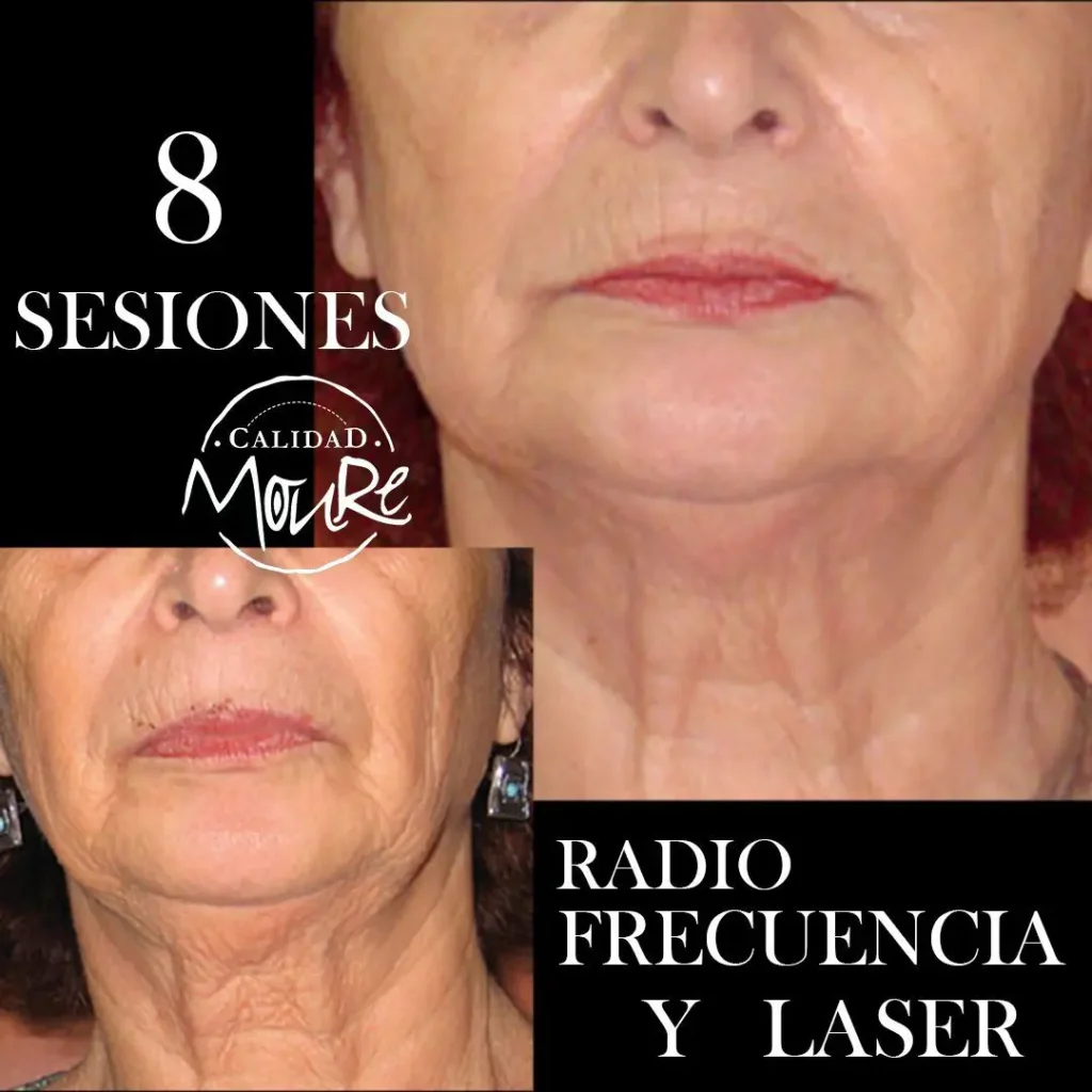 RADIOFRECUENCIA-LASER-GALVANICA-Y-ACIDO-HIALURONICO-CENTRO-DE-ESTETICA-MOURE-MALLORCA-6