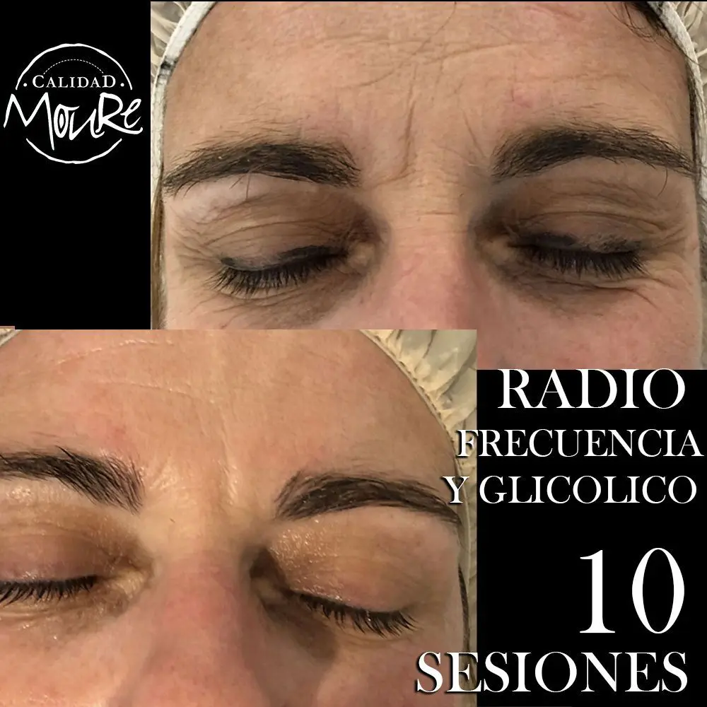 RADIOFRECUENCIA-LASER-GALVANICA-Y-ACIDO-HIALURONICO-CENTRO-DE-ESTETICA-MOURE-MALLORCA-7