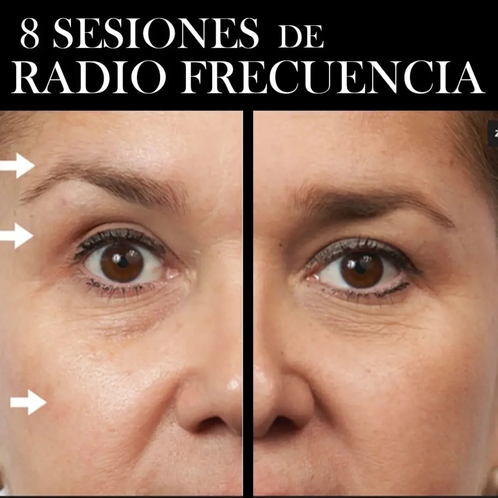 RADIOFRECUENCIA-LASER-GALVANICA-Y-ACIDO-HIALURONICO-CENTRO-DE-ESTETICA-MOURE-MALLORCA-8