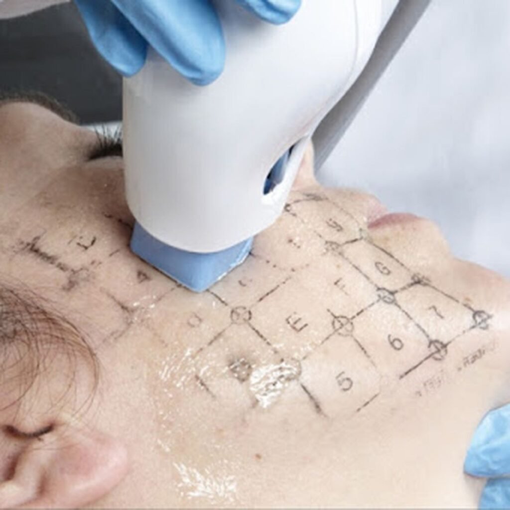RADIOFRECUENCIA-LASER-GALVANICA-Y-ACIDO-HIALURONICO-CENTRO-DE-ESTETICA-MOURE-MALLORCA-9