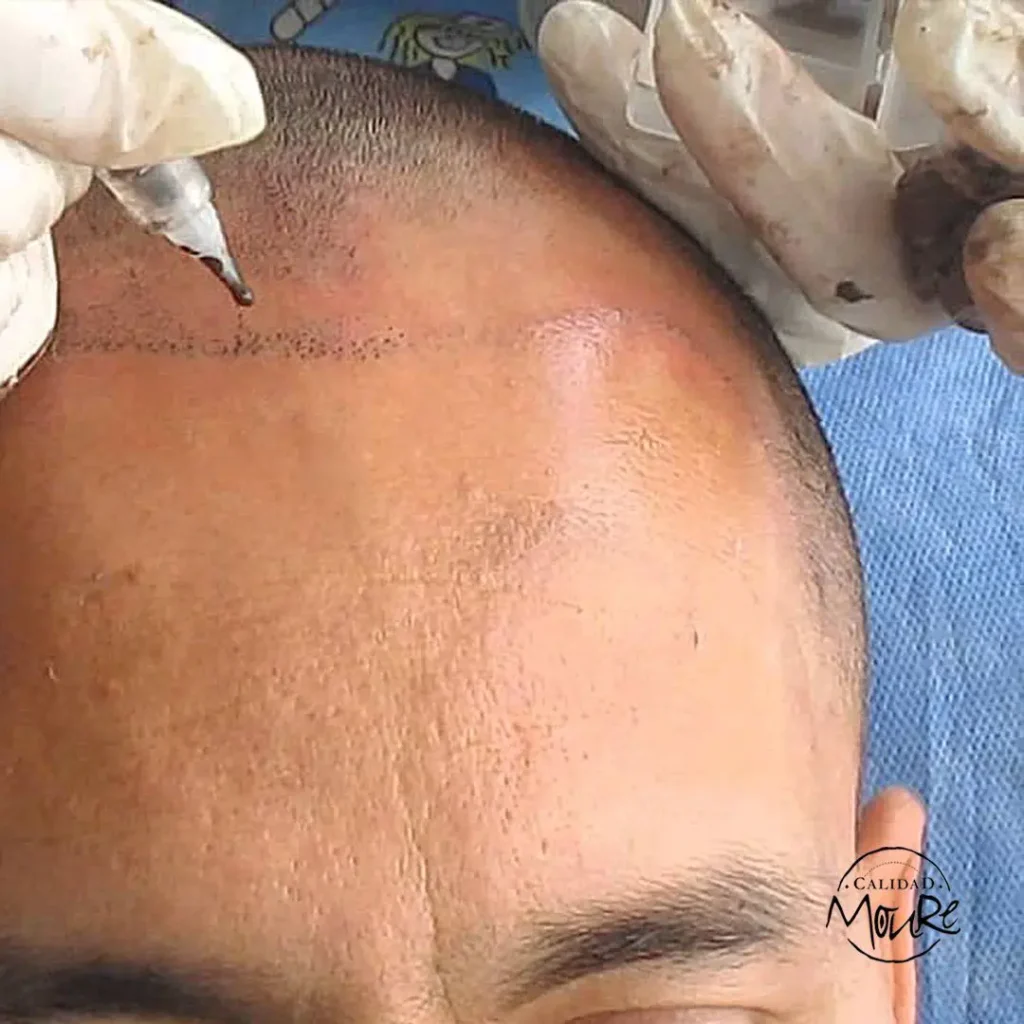 TECNICA-DE-REALIZACION-DE-MICROPIGMENTACION-CAPILAR-2