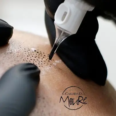 TECNICA-DE-REALIZACION-DE-MICROPIGMENTACION-CAPILAR-7