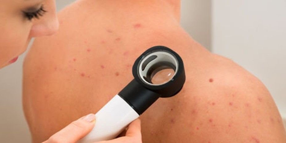 TRATAMIENTO-DE-ACNE-EN-LA-ESPALDA-MALLORCA-CENTROS-MOURE-10