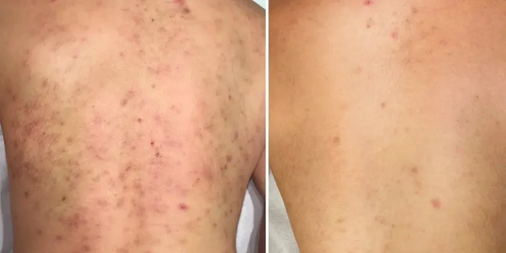 TRATAMIENTO-DE-ACNE-EN-LA-ESPALDA-MALLORCA-CENTROS-MOURE-12