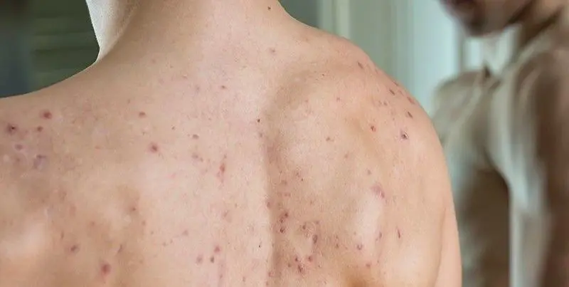 TRATAMIENTO-DE-ACNE-EN-LA-ESPALDA-MALLORCA-CENTROS-MOURE-13