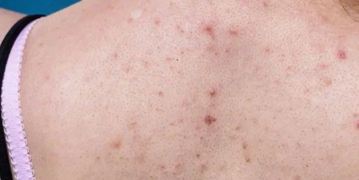 TRATAMIENTO-DE-ACNE-EN-LA-ESPALDA-MALLORCA-CENTROS-MOURE-16