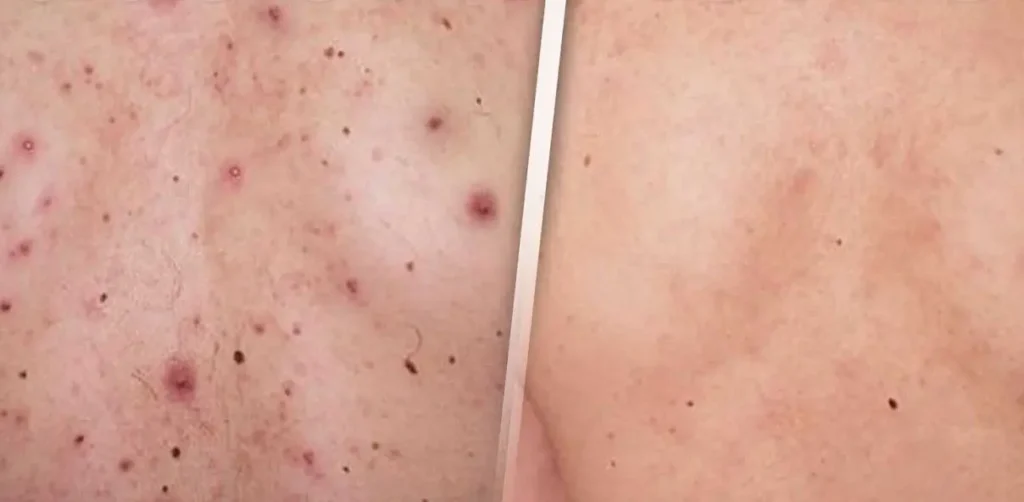 TRATAMIENTO-DE-ACNE-EN-LA-ESPALDA-MALLORCA-CENTROS-MOURE-17