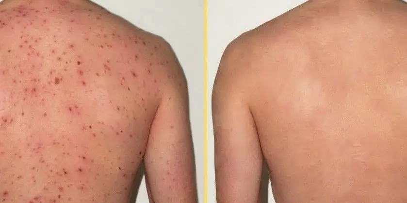 TRATAMIENTO-DE-ACNE-EN-LA-ESPALDA-MALLORCA-CENTROS-MOURE-2