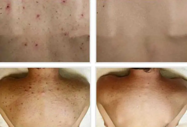 TRATAMIENTO-DE-ACNE-EN-LA-ESPALDA-MALLORCA-CENTROS-MOURE-3