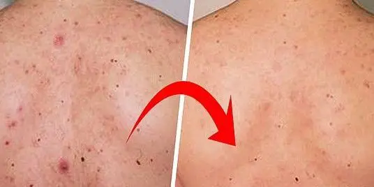 TRATAMIENTO-DE-ACNE-EN-LA-ESPALDA-MALLORCA-CENTROS-MOURE-6