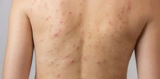 TRATAMIENTO-DE-ACNE-EN-LA-ESPALDA-MALLORCA-CENTROS-MOURE-8