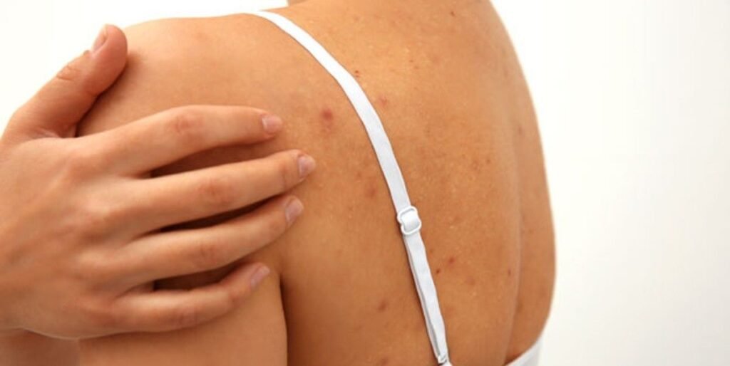 TRATAMIENTO-DE-ACNE-EN-LA-ESPALDA-MALLORCA-CENTROS-MOURE-9