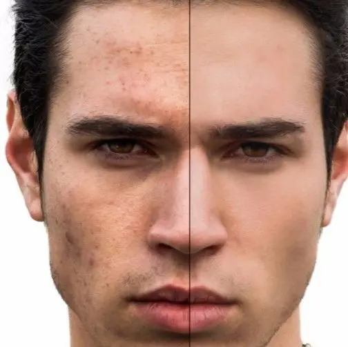 TRATAMIENTO-FACIAL-HOMBRE-ANTES-Y-DESPUES-BARBERIA-PELUQUERIA-MALLORCA-MOURE-2