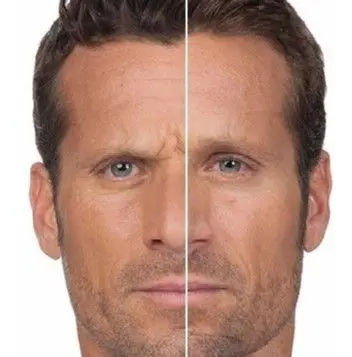 TRATAMIENTO-FACIAL-HOMBRE-ANTES-Y-DESPUES-BARBERIA-PELUQUERIA-MALLORCA-MOURE-7