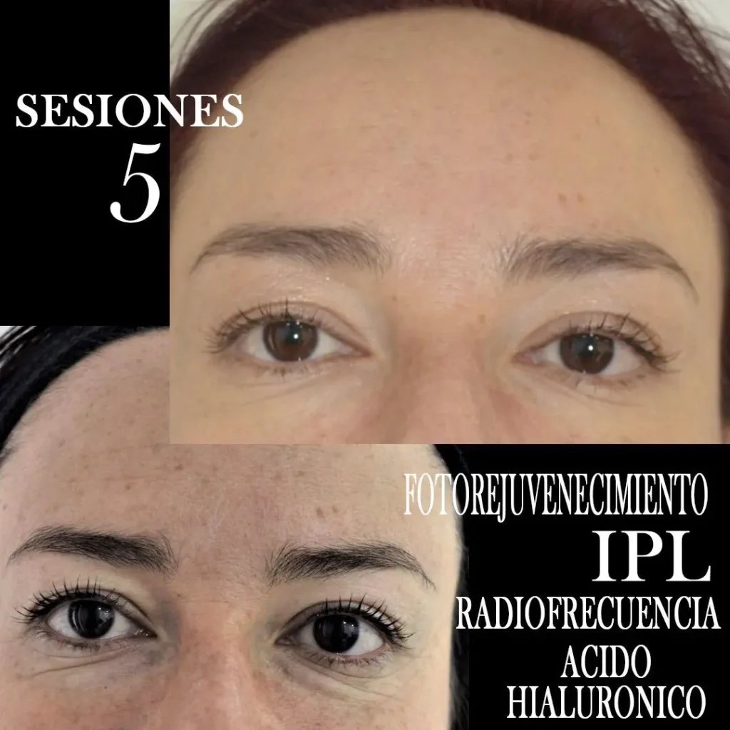 TRATAMIENTO-FOTOREJUVENECIMIENTO-FACIAL-CENTROS-MOURE-MALLORCA-1