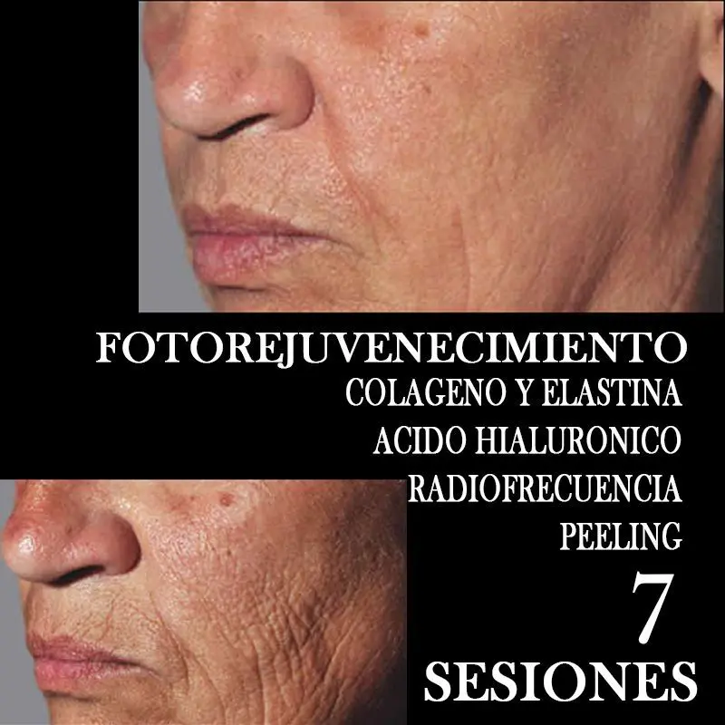 TRATAMIENTO-FOTOREJUVENECIMIENTO-FACIAL-CENTROS-MOURE-MALLORCA-2