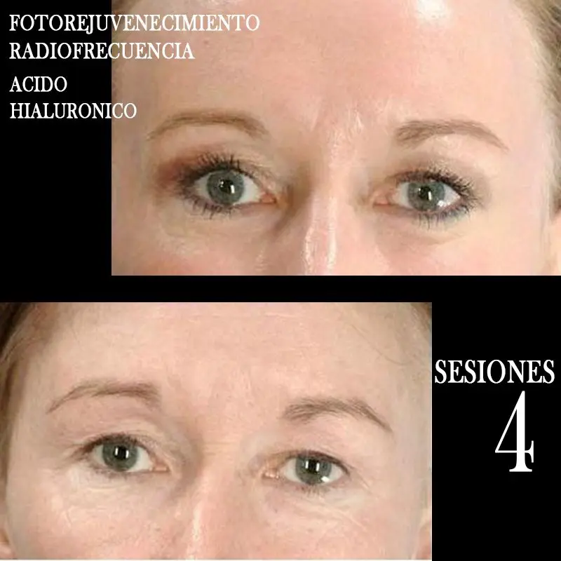 TRATAMIENTO-FOTOREJUVENECIMIENTO-FACIAL-CENTROS-MOURE-MALLORCA-3