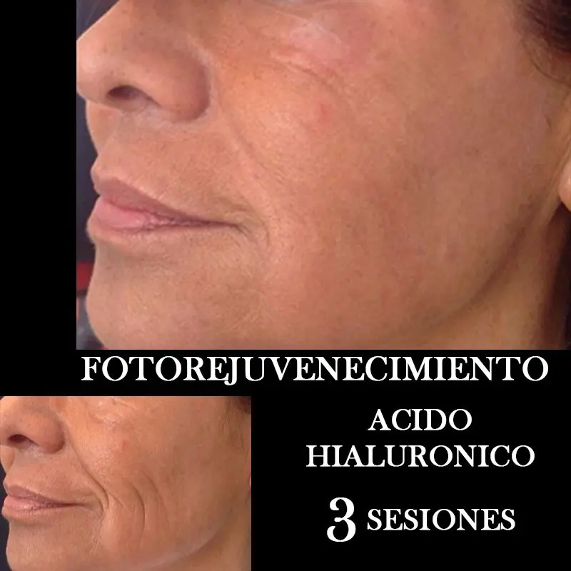 TRATAMIENTO-FOTOREJUVENECIMIENTO-FACIAL-CENTROS-MOURE-MALLORCA-6