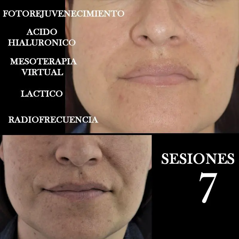 TRATAMIENTO-FOTOREJUVENECIMIENTO-FACIAL-CENTROS-MOURE-MALLORCA-7