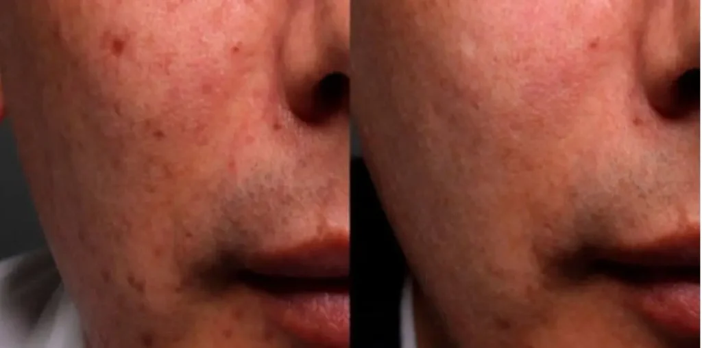 TRATAMIENTO-PARA-QUITAR-MARCAS-DE-ACNE-1
