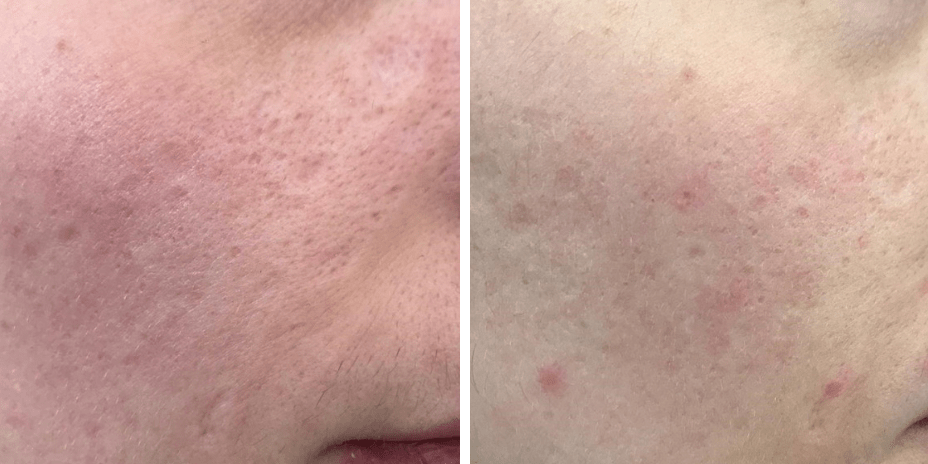 TRATAMIENTO-PARA-QUITAR-MARCAS-DE-ACNE-1