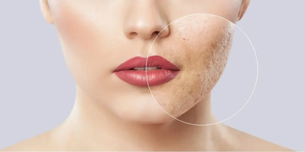 TRATAMIENTO-PARA-QUITAR-MARCAS-DE-ACNE-2