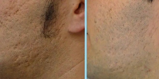 TRATAMIENTO-PARA-QUITAR-MARCAS-DE-ACNE-3