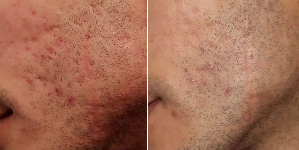TRATAMIENTO-PARA-QUITAR-MARCAS-DE-ACNE-4