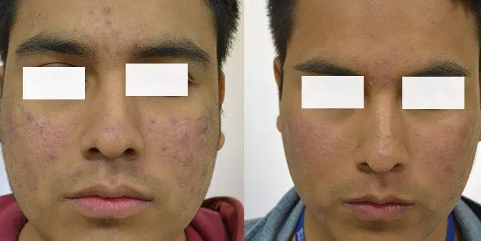 TRATAMIENTO-PARA-QUITAR-MARCAS-DE-ACNE-5