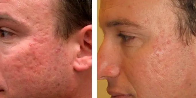 TRATAMIENTO-PARA-QUITAR-MARCAS-DE-ACNE-6