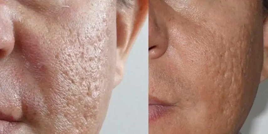 TRATAMIENTO-PARA-QUITAR-MARCAS-DE-ACNE-7