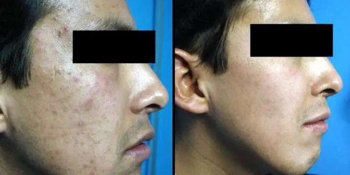 TRATAMIENTO-PARA-QUITAR-MARCAS-DE-ACNE-8