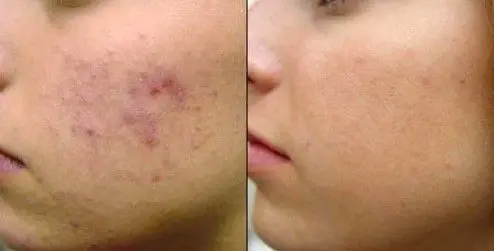 TRATAMIENTO-PARA-QUITAR-MARCAS-DE-ACNE-9