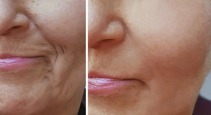 antes-y-despues-de-hialuronico-radiofreciencia-acidos-y-mesoterapia-1